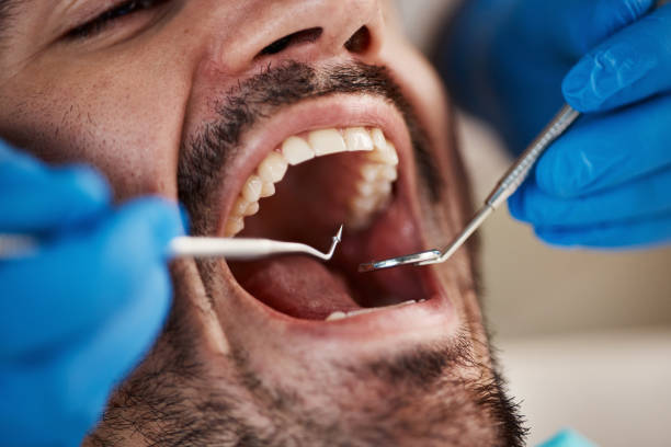 Best Knocked-Out Tooth (Avulsed Tooth) Treatment in Sophia, WV
